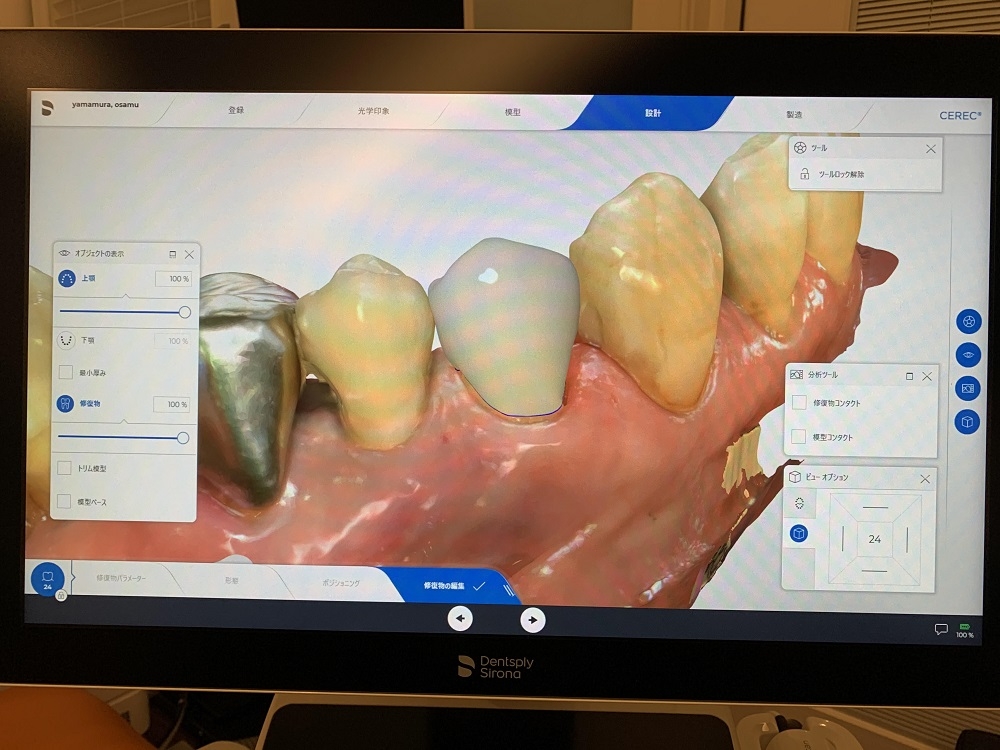 虫歯の最先端治療　『CEREC（セレック）』とは