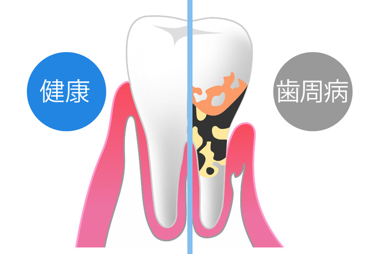 歯周病の症状とは？